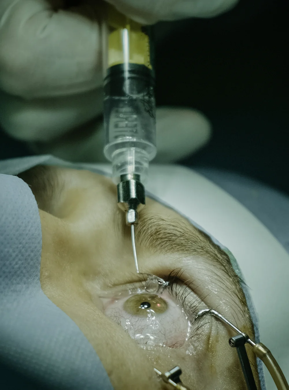 Diabetic Retinopathy