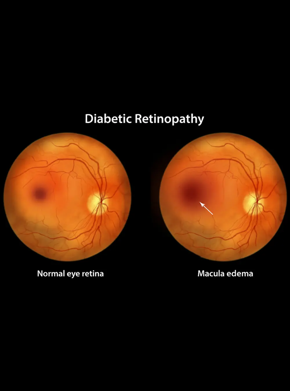 Diabetic Retinopathy