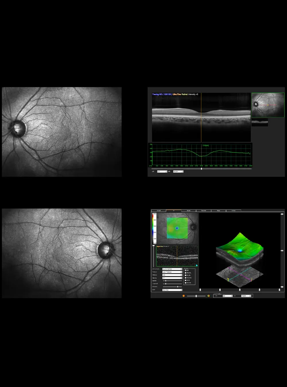 Diabetic Eye Disease