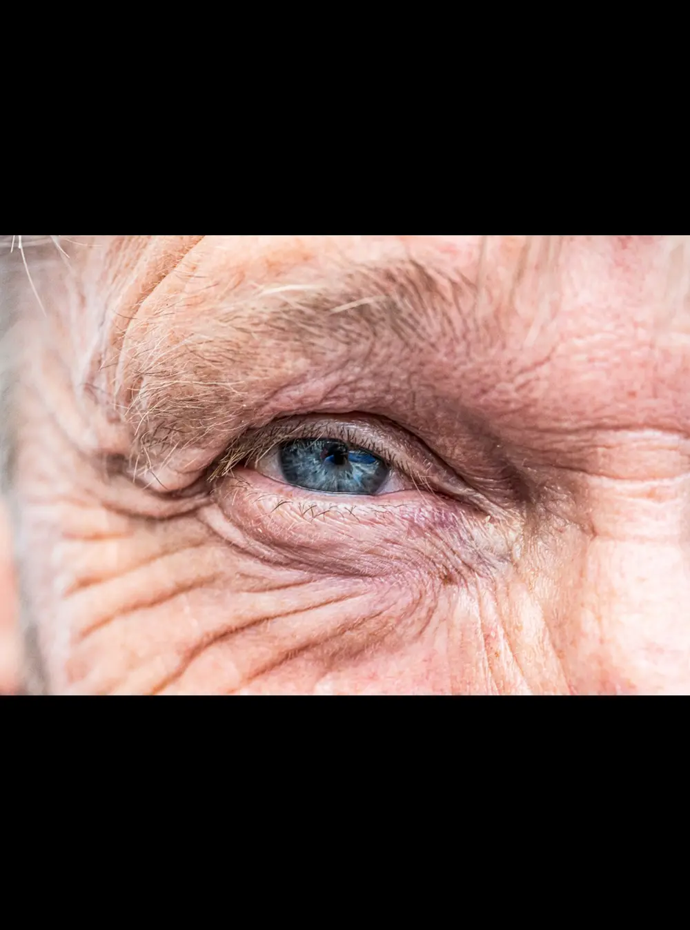 Diabetic Retinopathy
