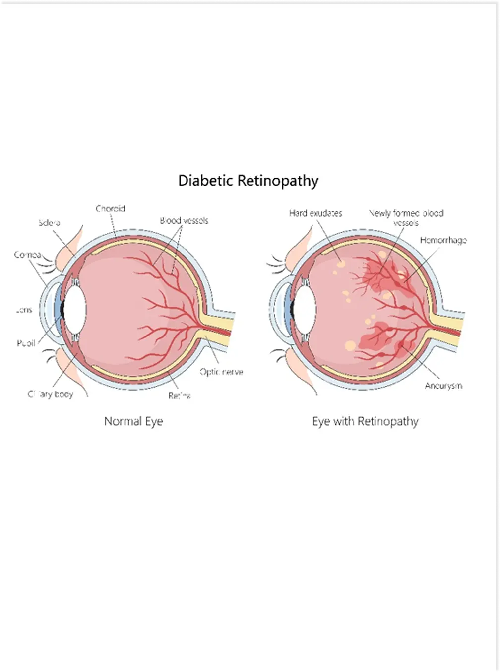 Diabetic Retinopathy