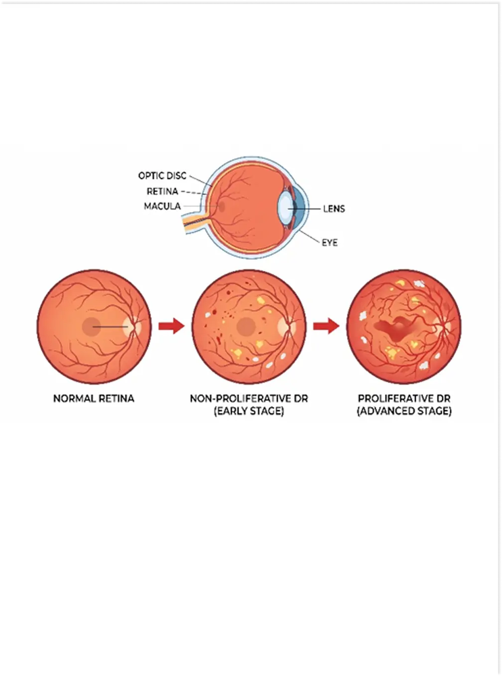 Diabetic Eye Disease