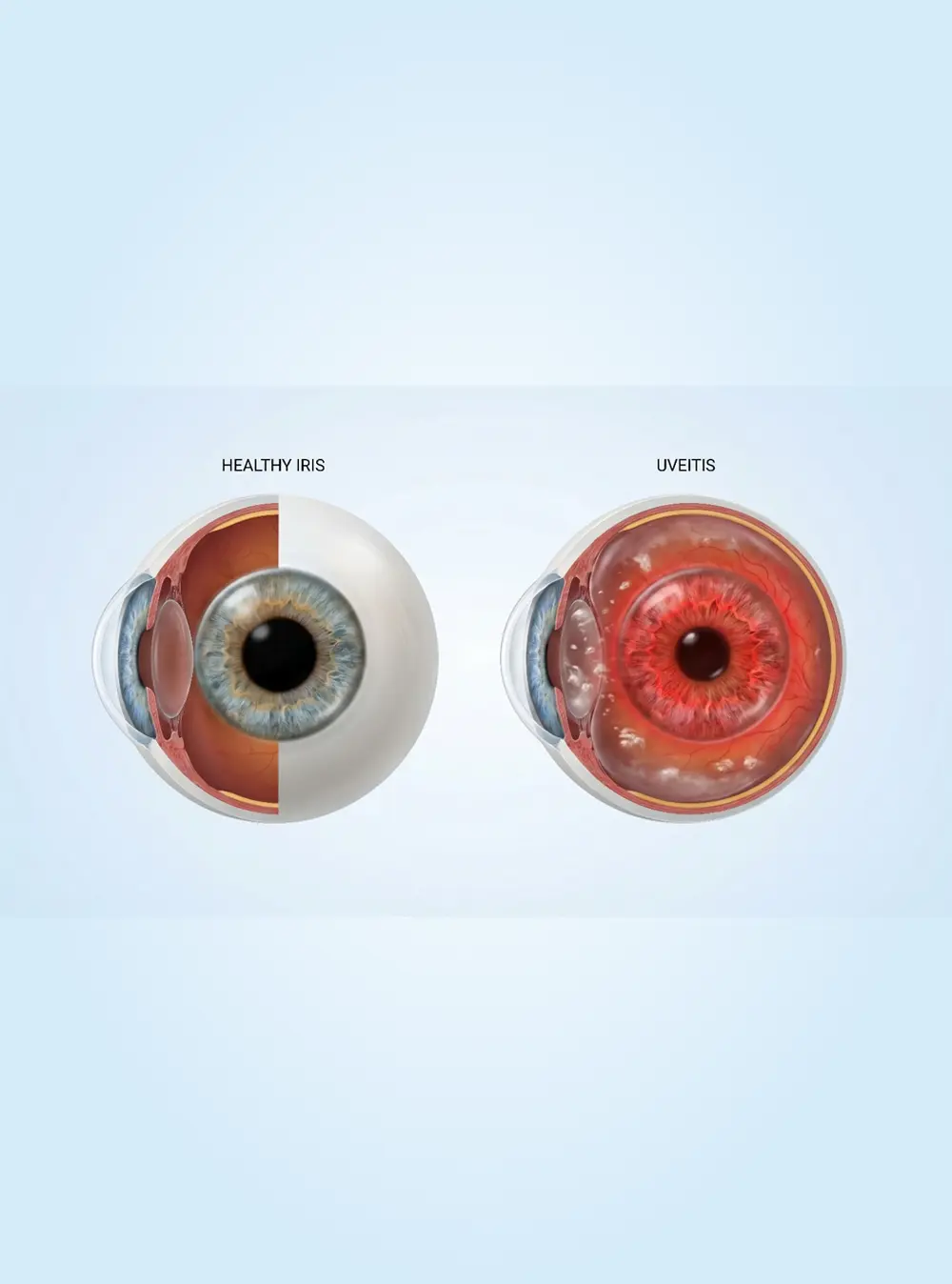 Diabetic Retinopathy