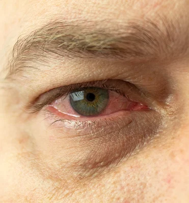 Diabetic Retinopathy