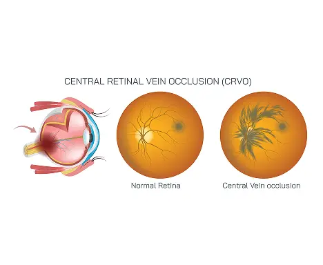 How Is Retinal Vascular Disease Diagnosed
