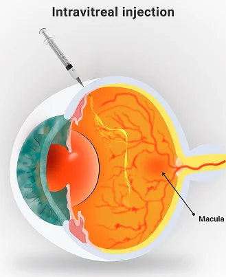 Diabetic Eye Symptoms