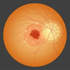 How Is Retinal Vascular Disease Diagnosed