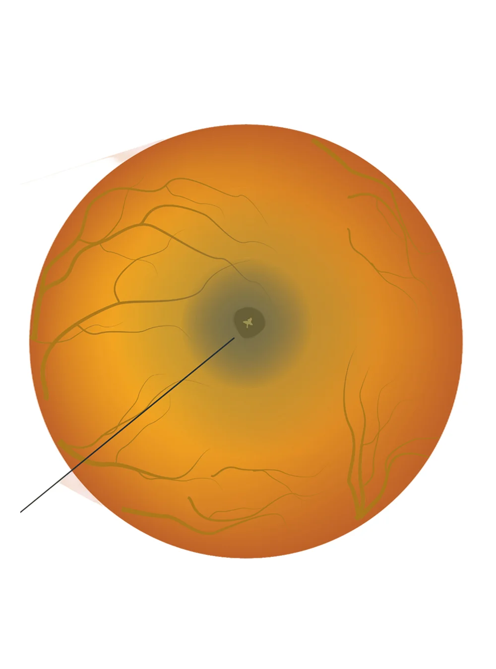 Diabetic Eye Disease