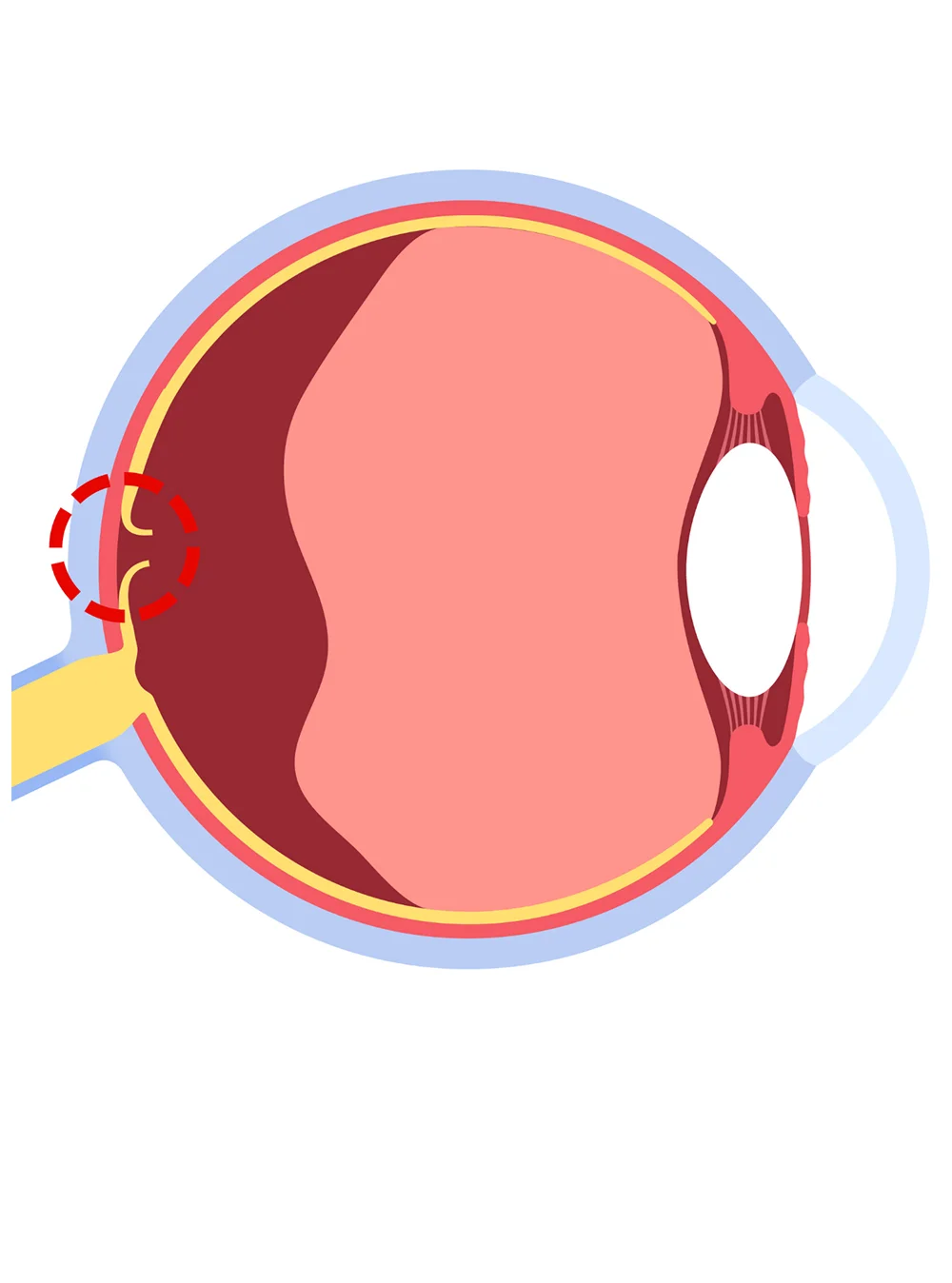 Diabetic Retinopathy