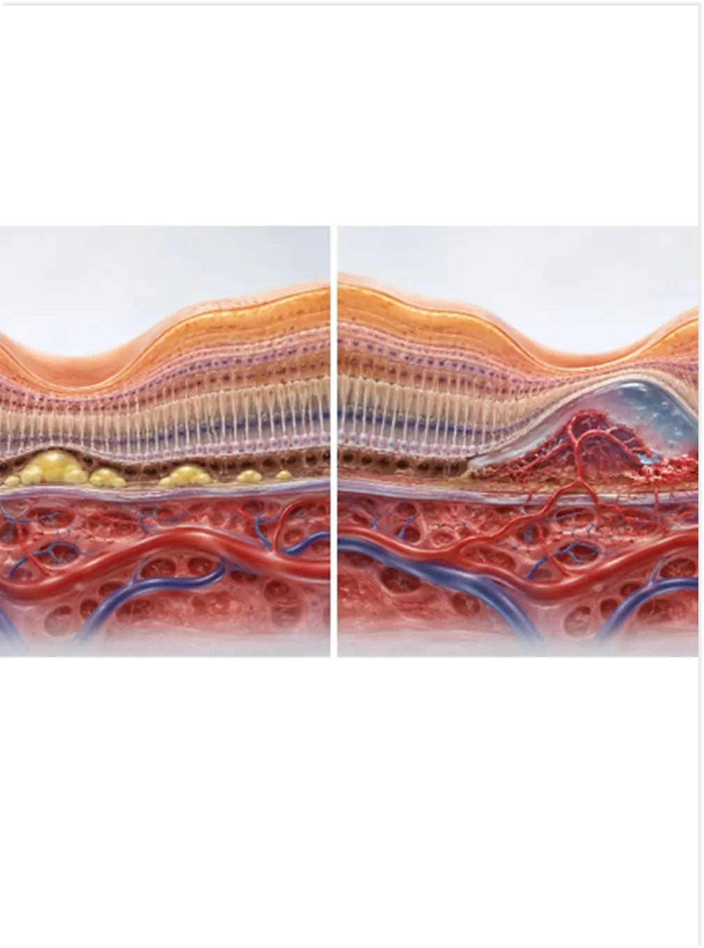 Photobiomodulation for Dry AMD
