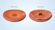 How Is Retinal Vascular Disease Diagnosed