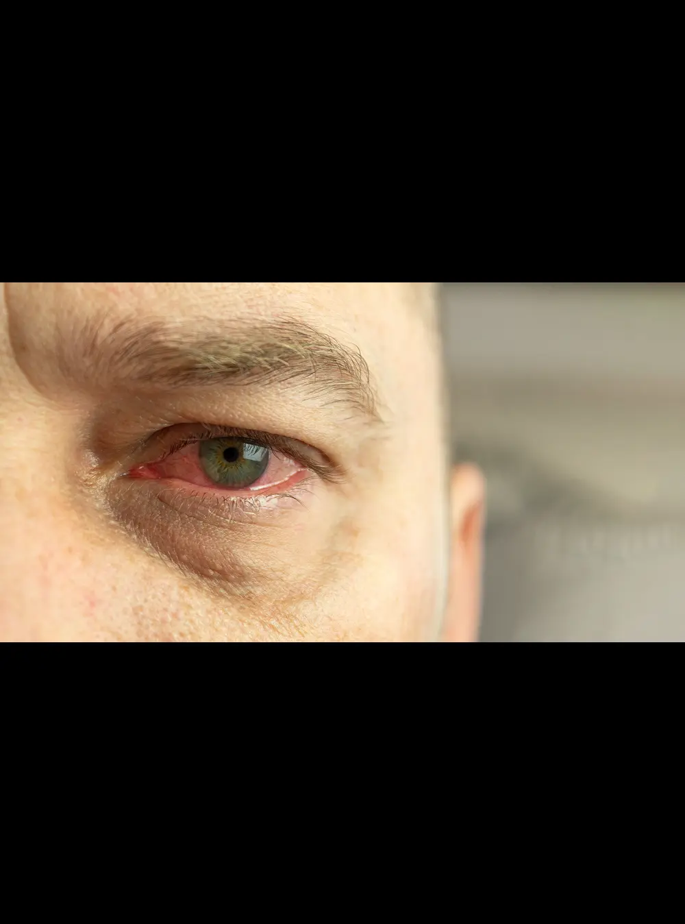 Diabetic Eye Disease