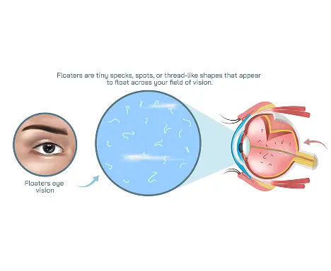 Early Detection