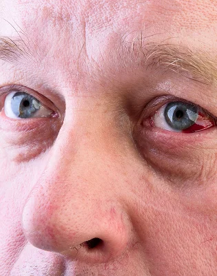 Retinal Tear