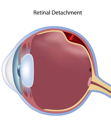Rhegmatogenous Retinal Detachment