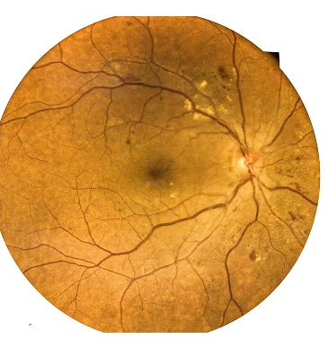 Tractional Retinal Detachment