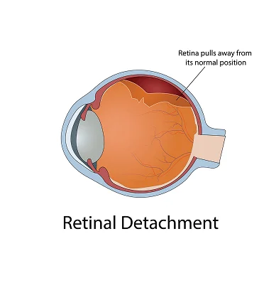 Exudative Retinal Detachment