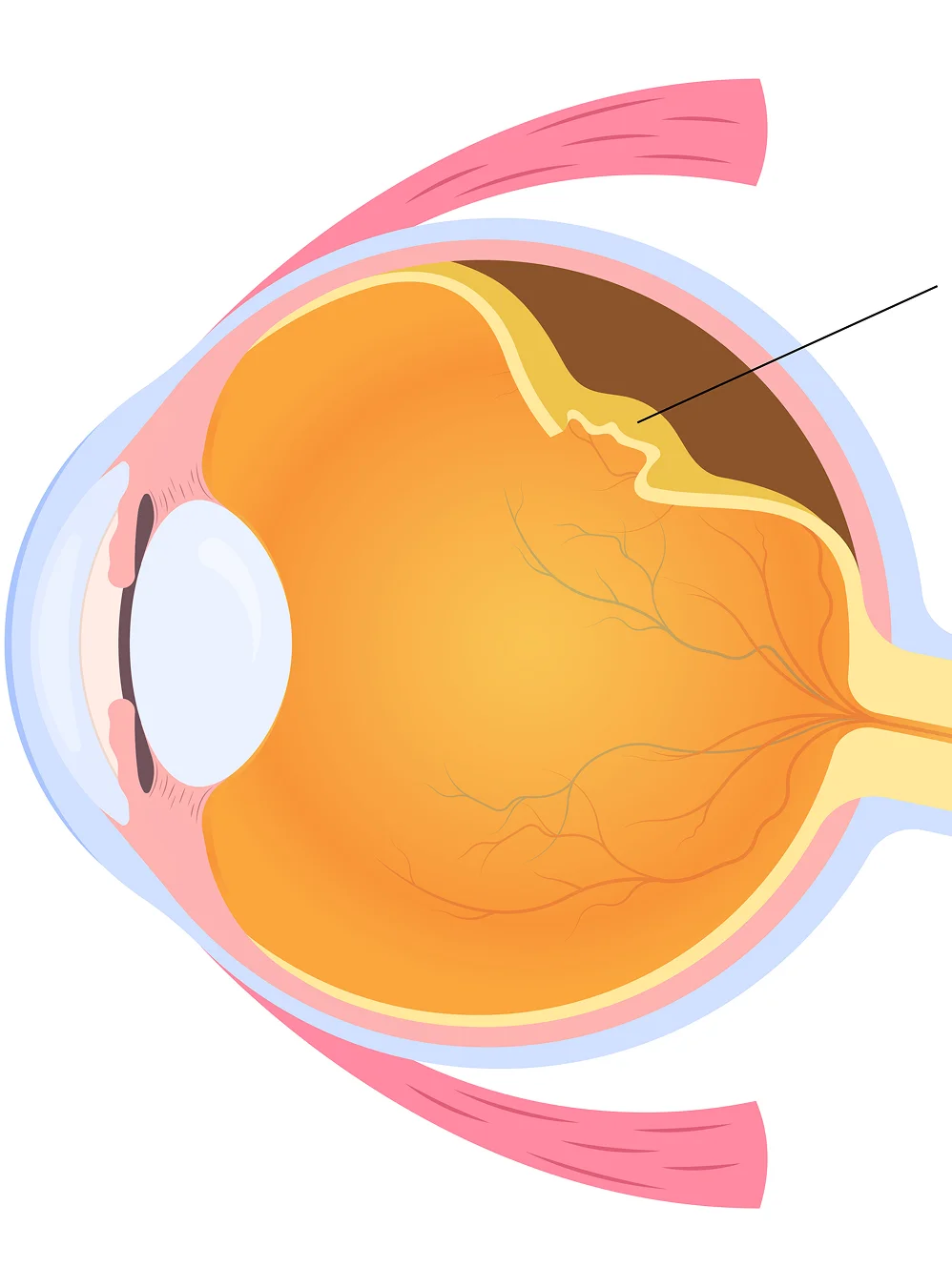 Types of Retinal Detachment