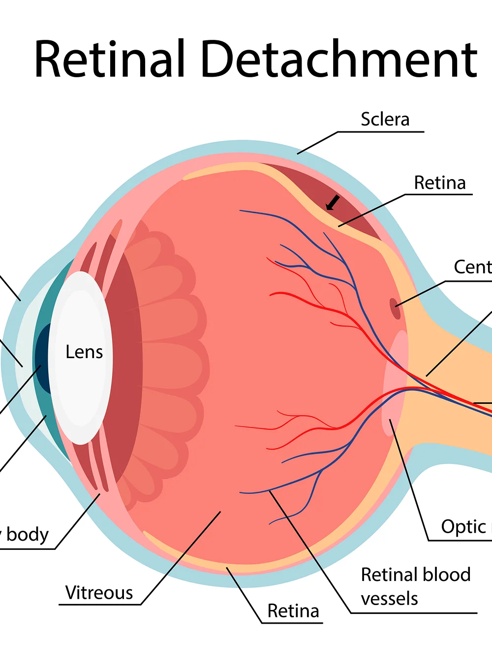 Retinal Detachment