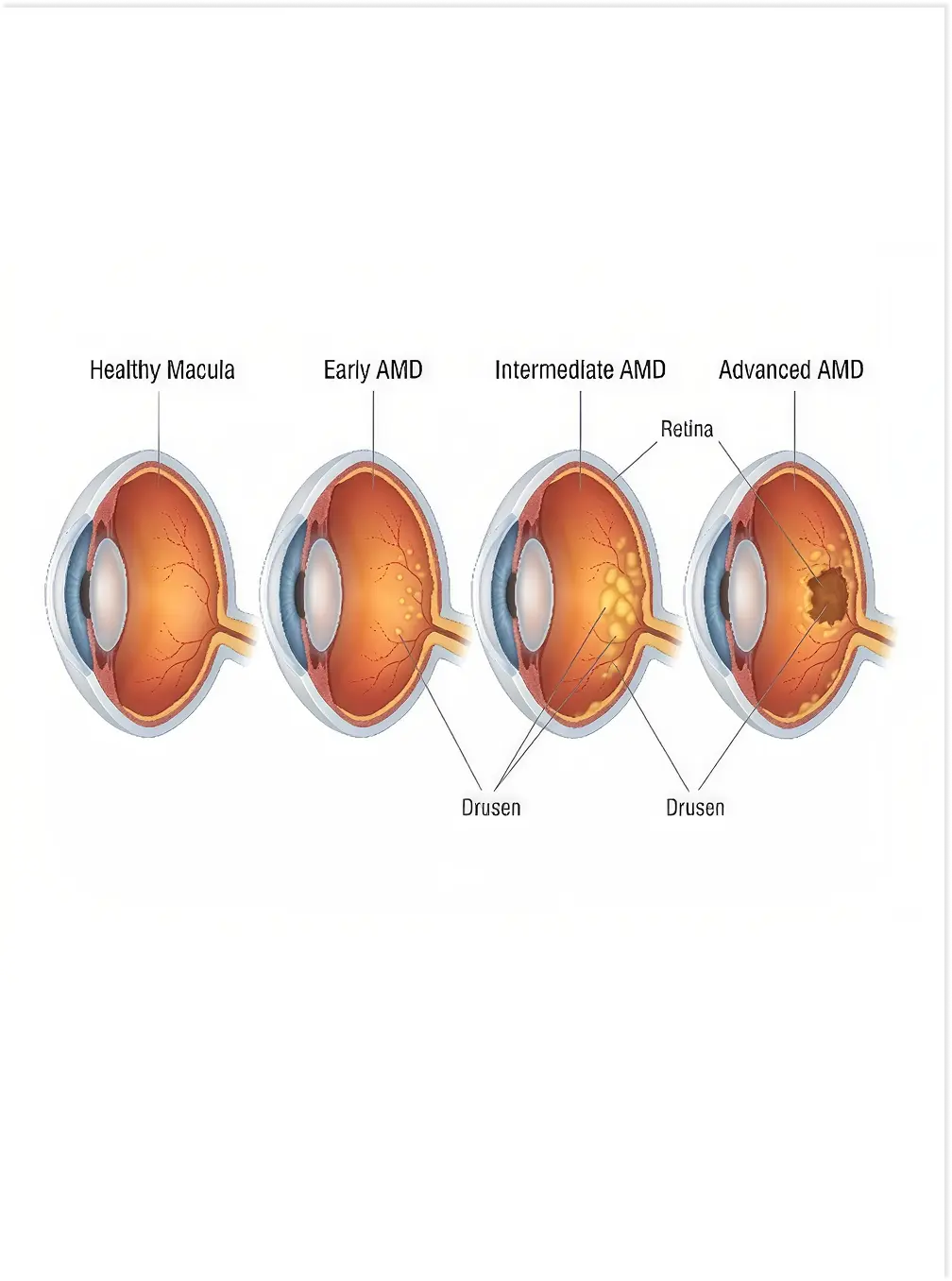 Photobiomodulation for Dry AMD