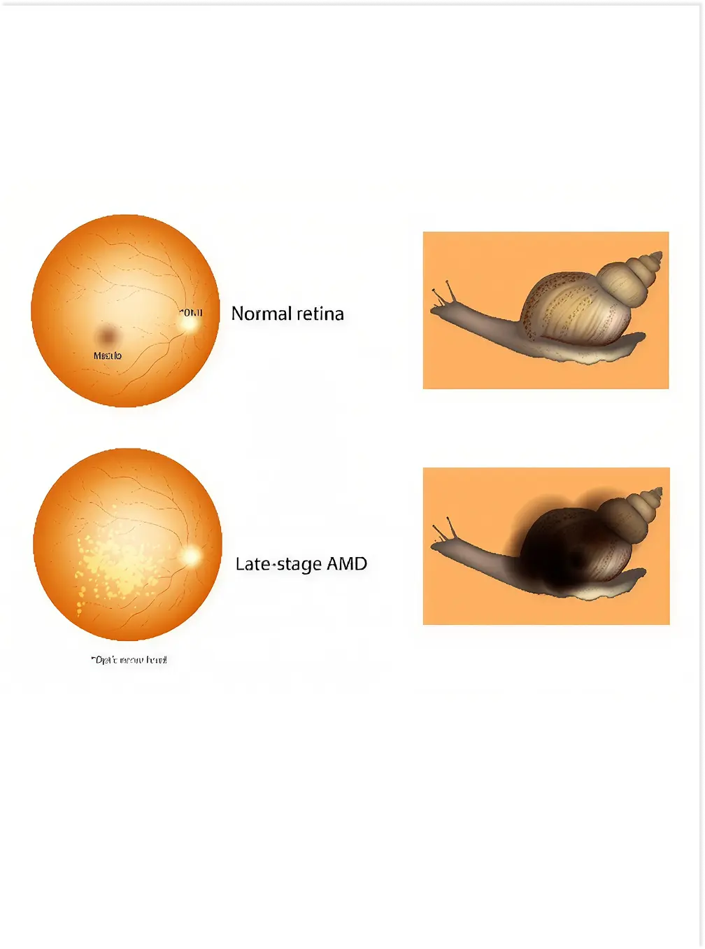 Photobiomodulation for Dry AMD
