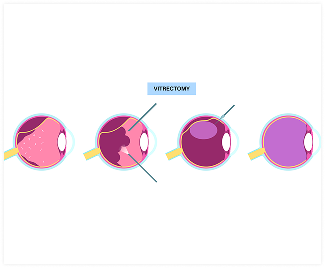 Early Detection