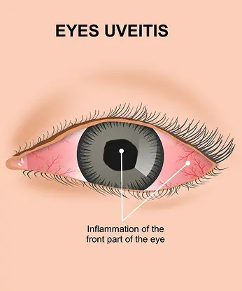 Early Detection