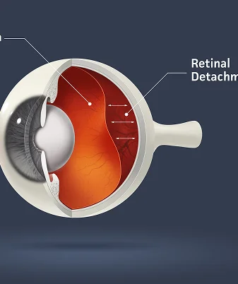 Retinal Screening