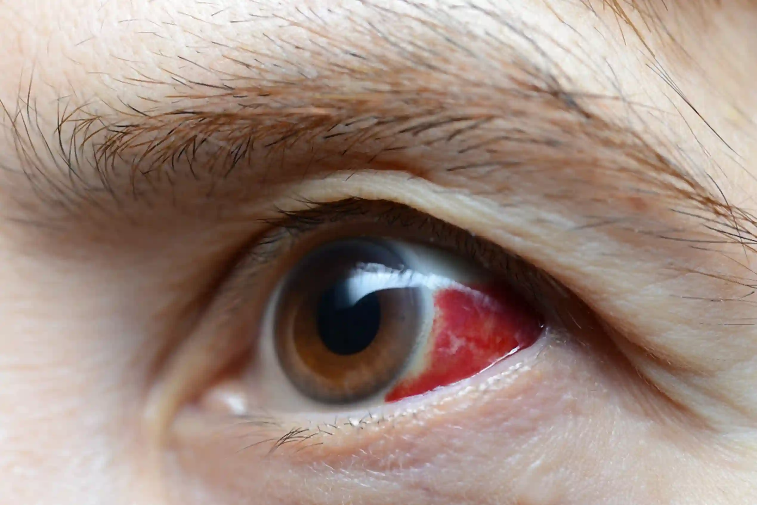 Bleeding Inside the Eye
