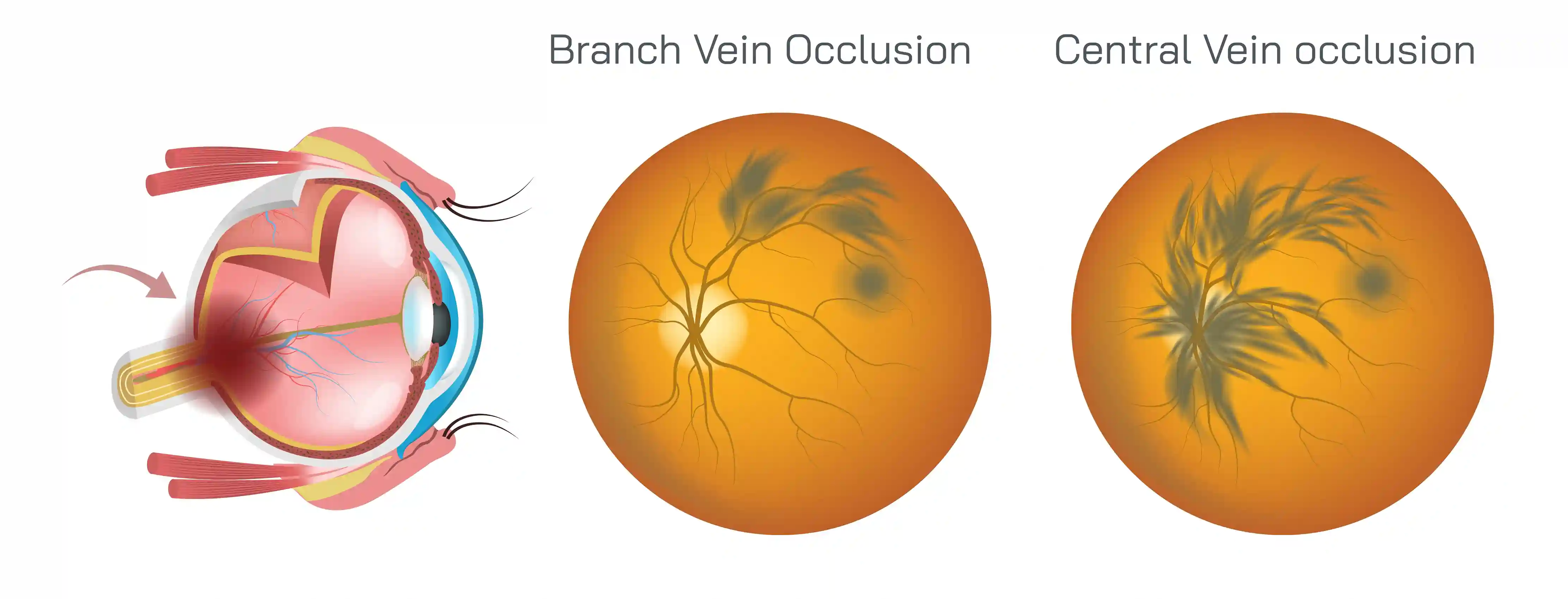 CRVO Retinal Vein Blockage