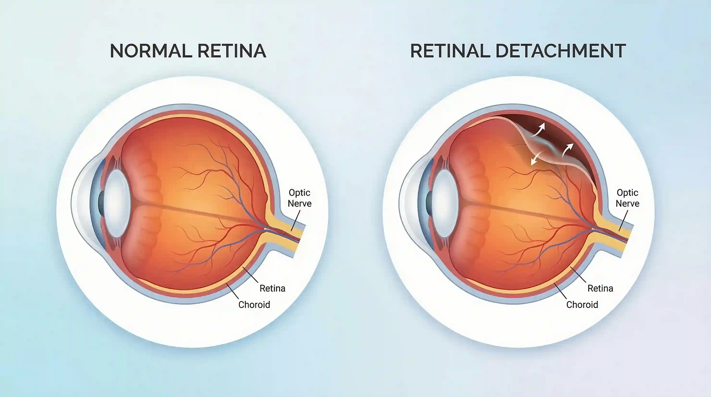 Retinal Detachment Diagram