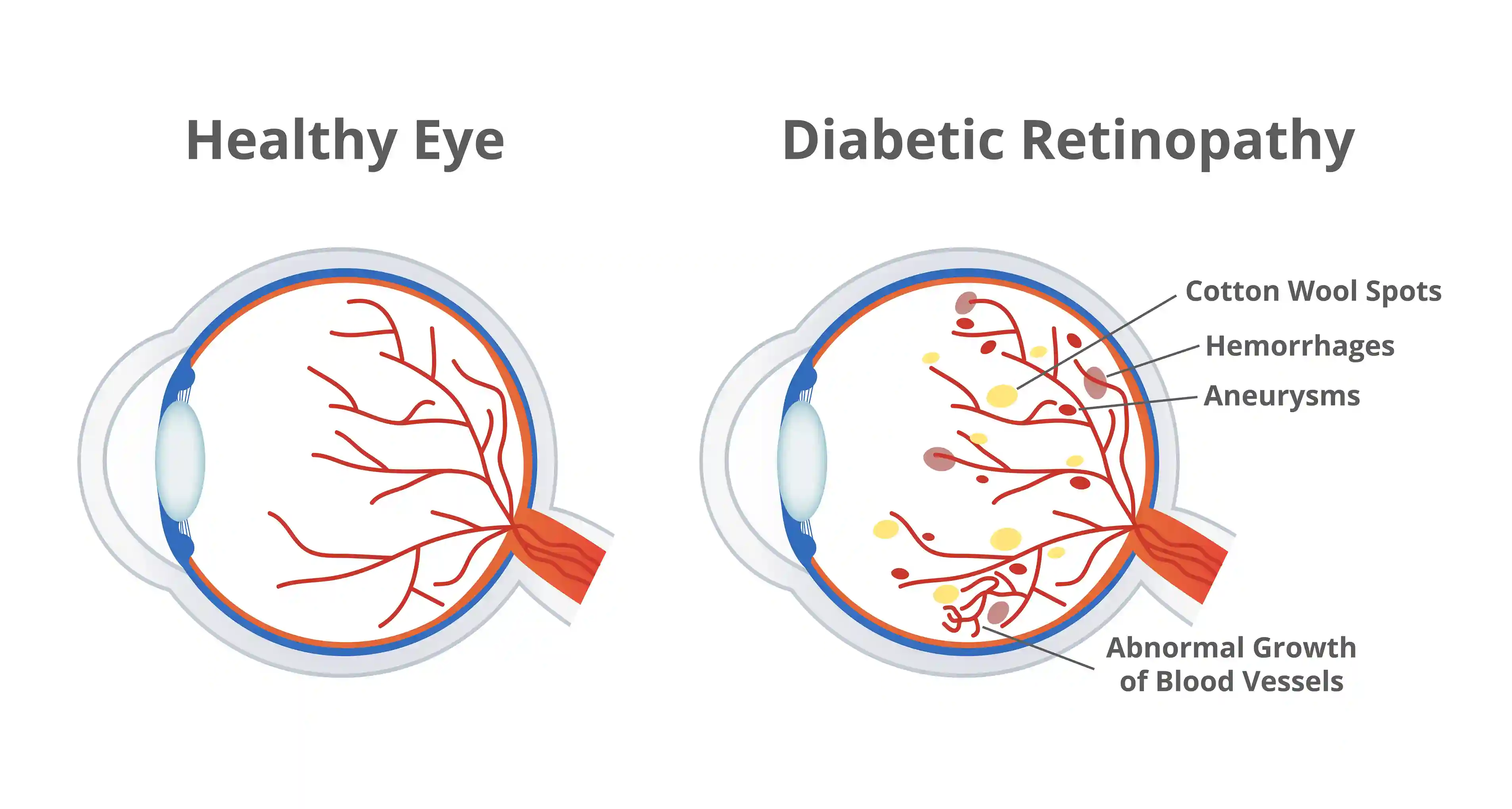 Diabetic Retinopathy Eye Condition