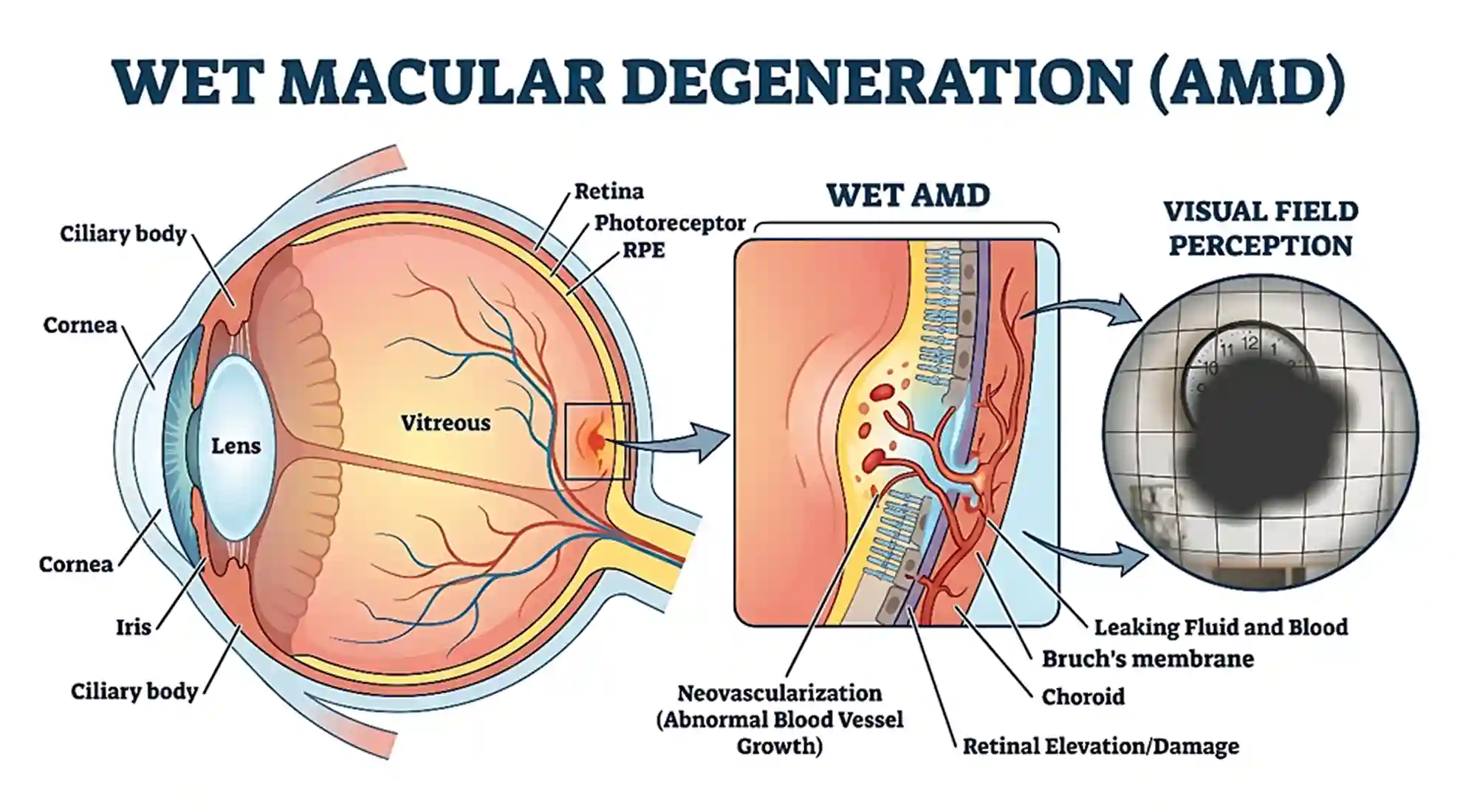 Wet AMD Diagram