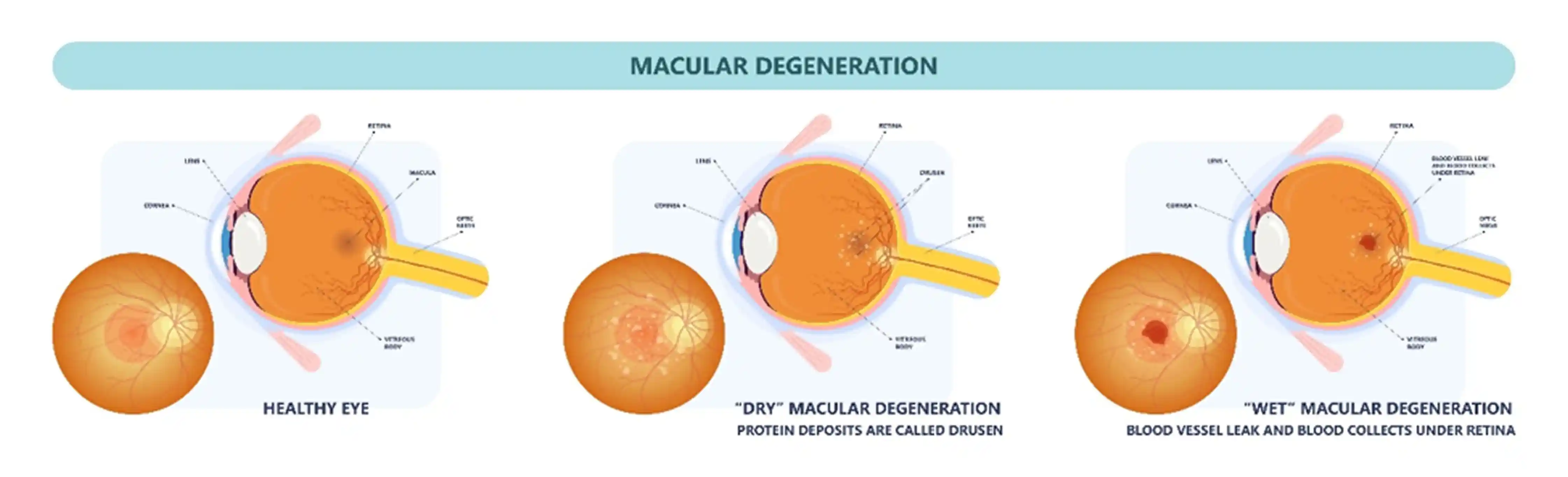 Diagram of Wet and Dry AMD