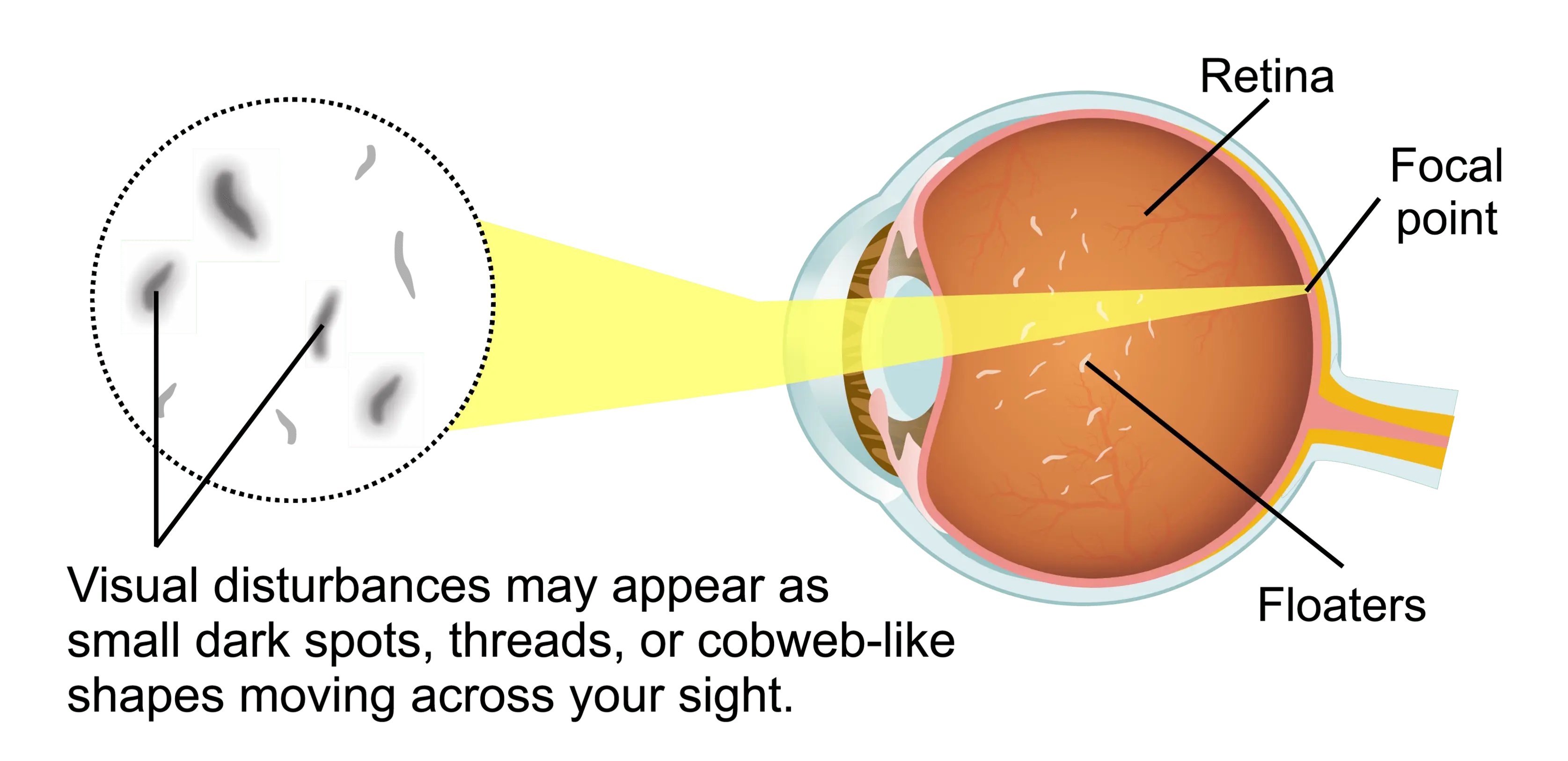 Vitreous Pulling on Retina