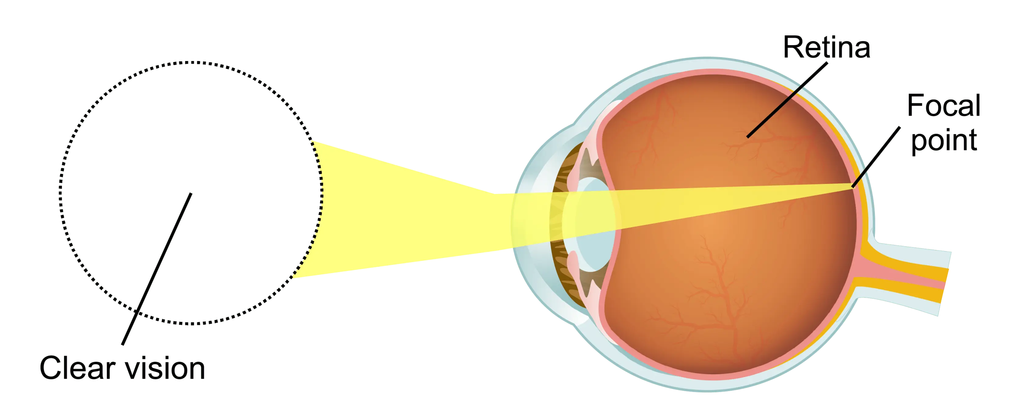 Retinal Warning Signs