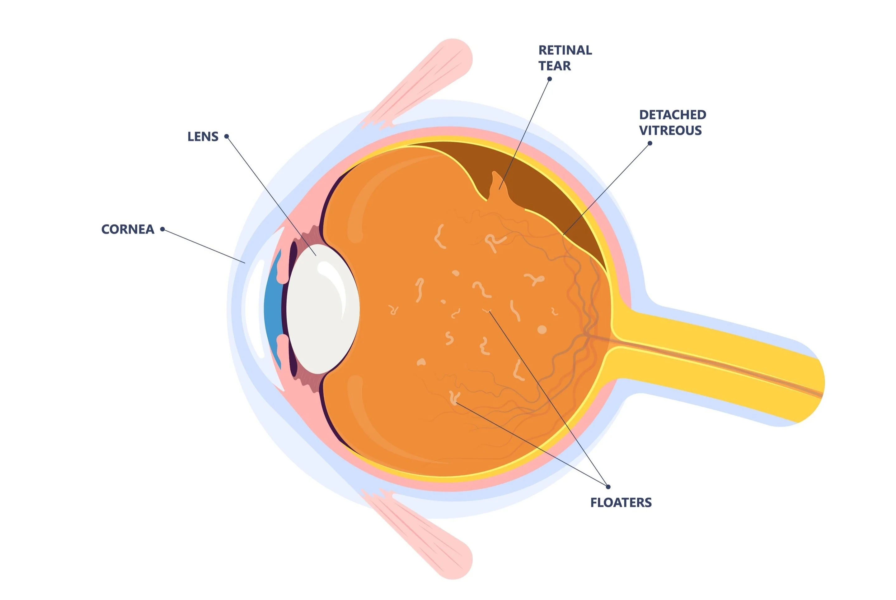 Diagram of Eye Floaters