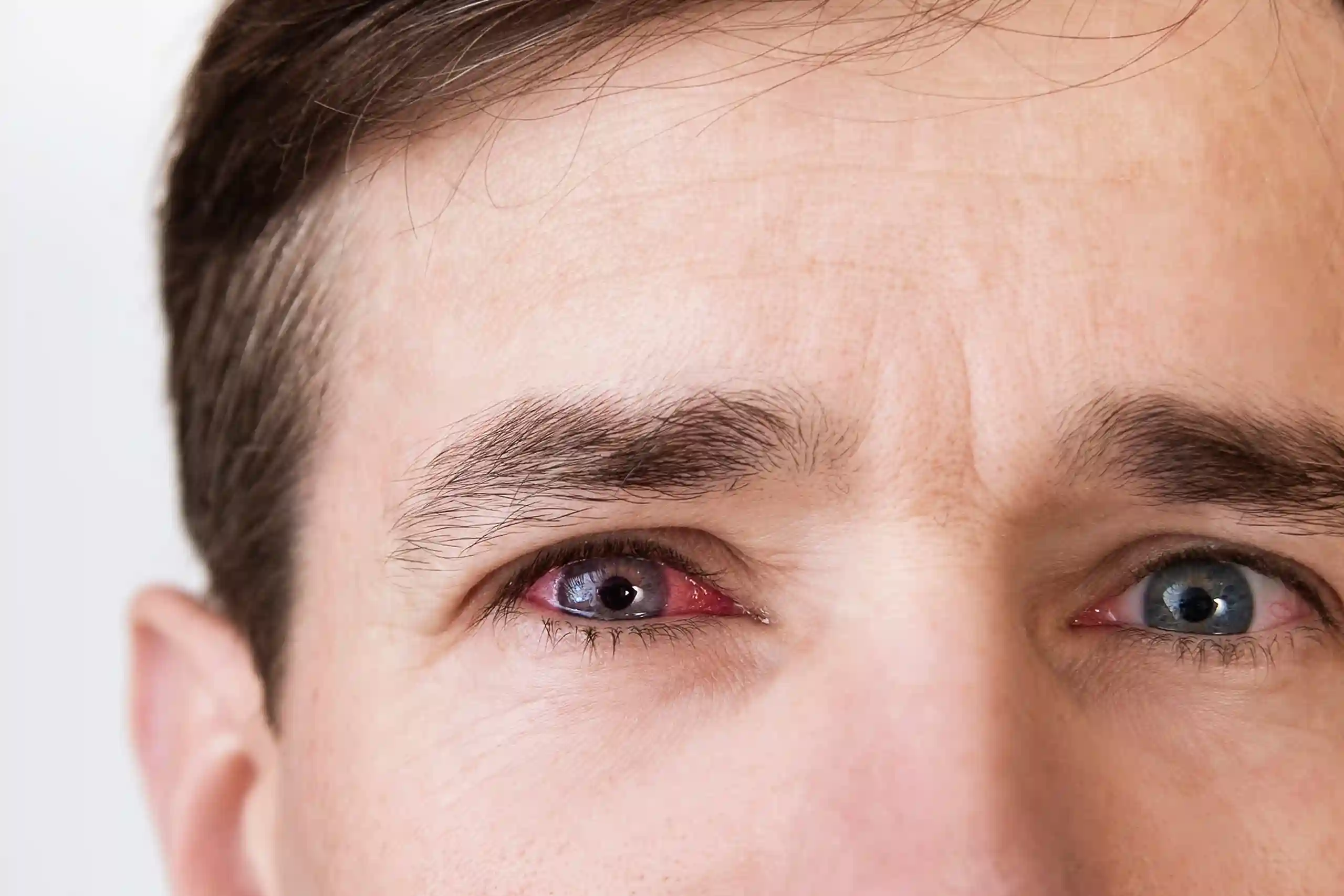 Hypertensive Retinopathy Eye