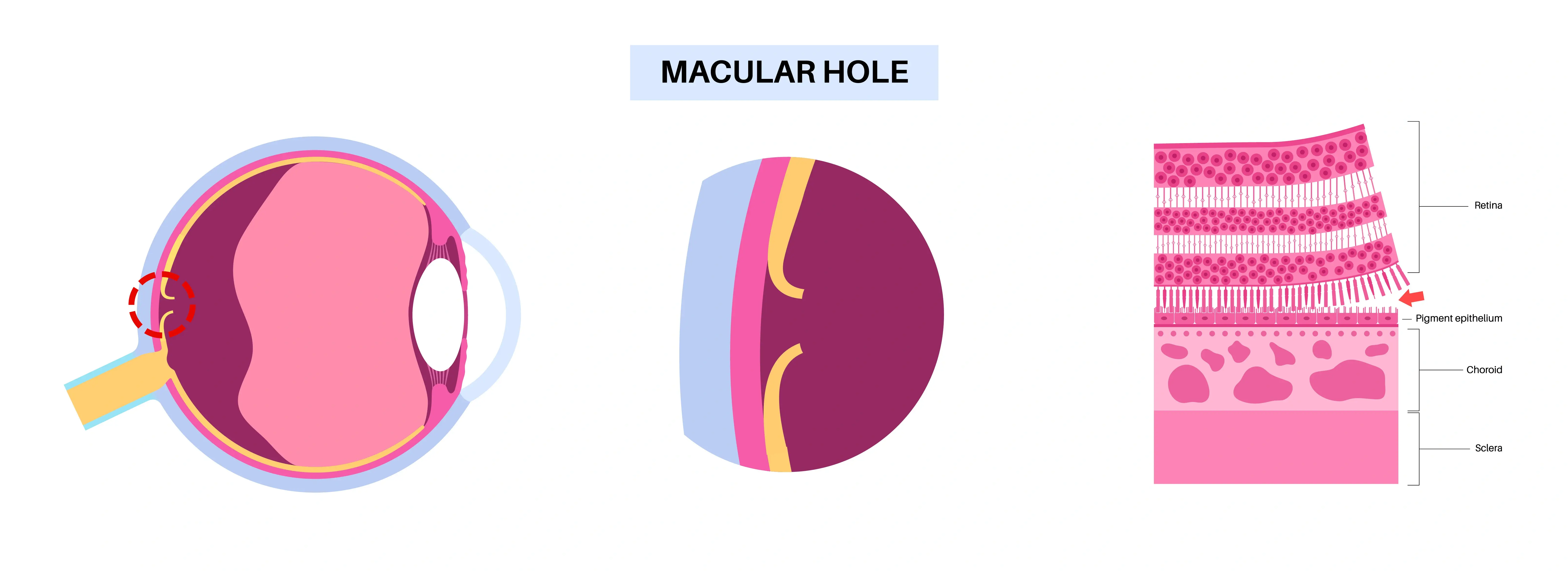 Macular Hole Diagram