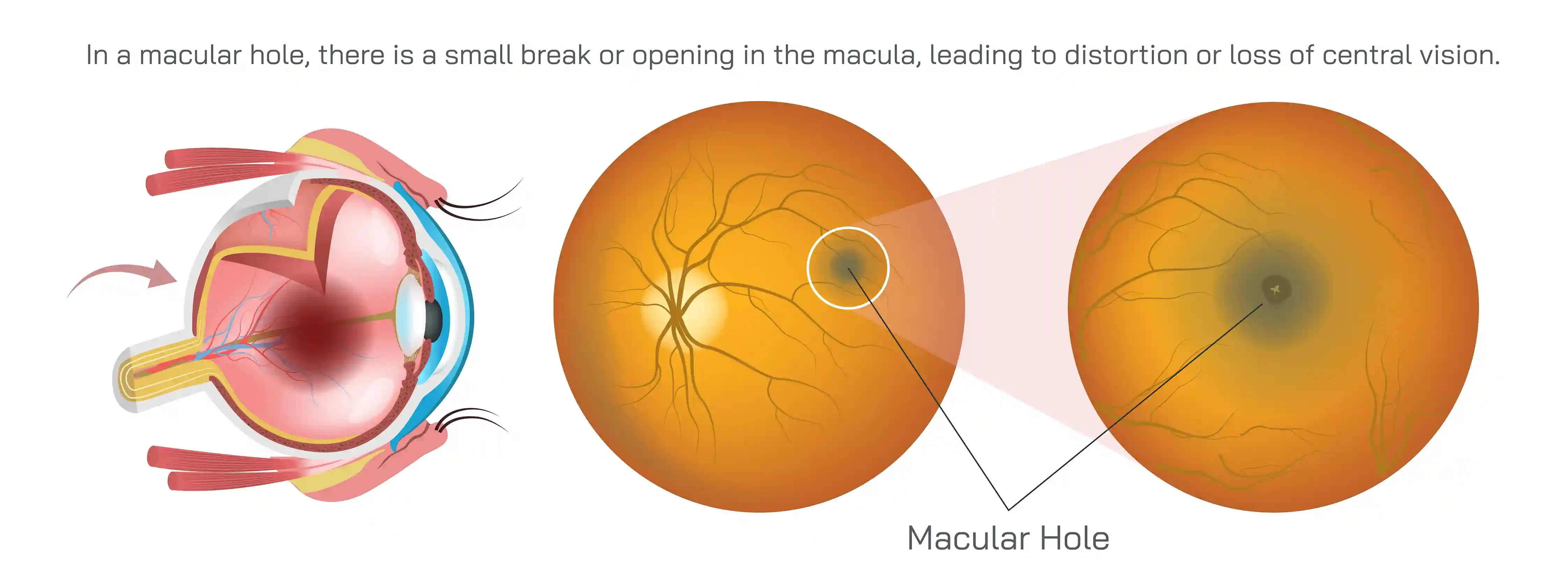Macular Puckering Diagram