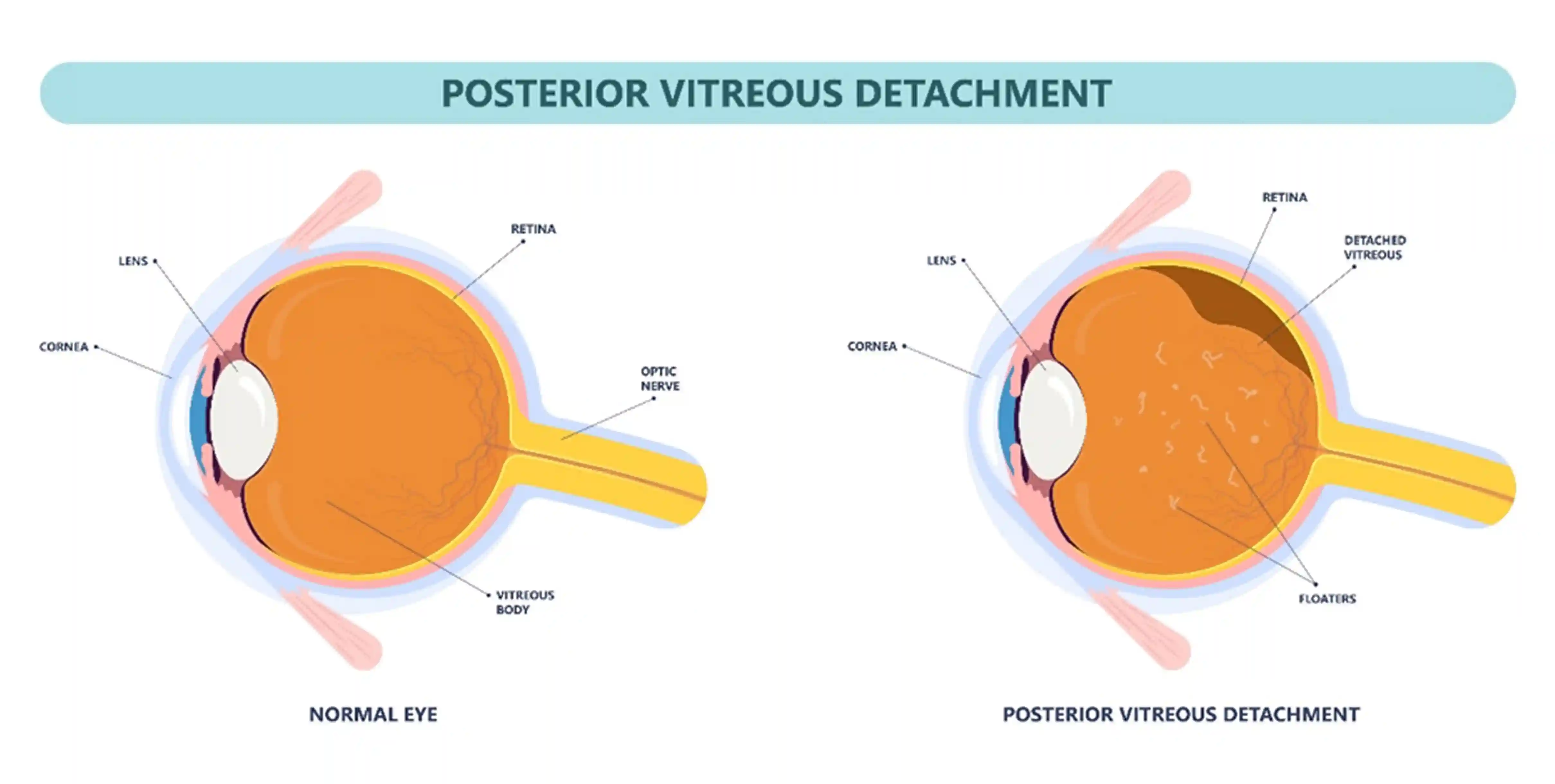 Normal Eye VS PVD Eye