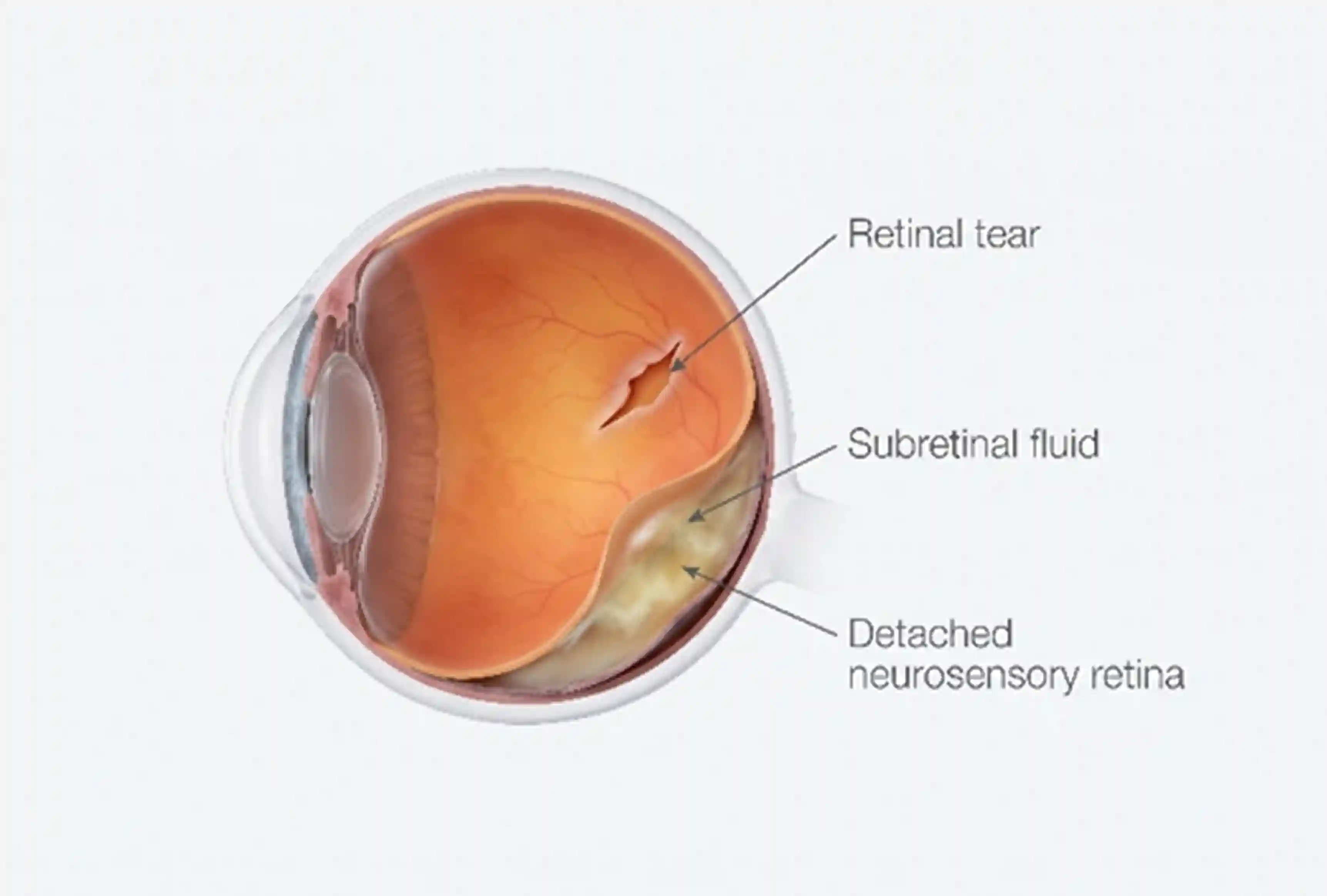 Cryotherapy for Retinal Tear 