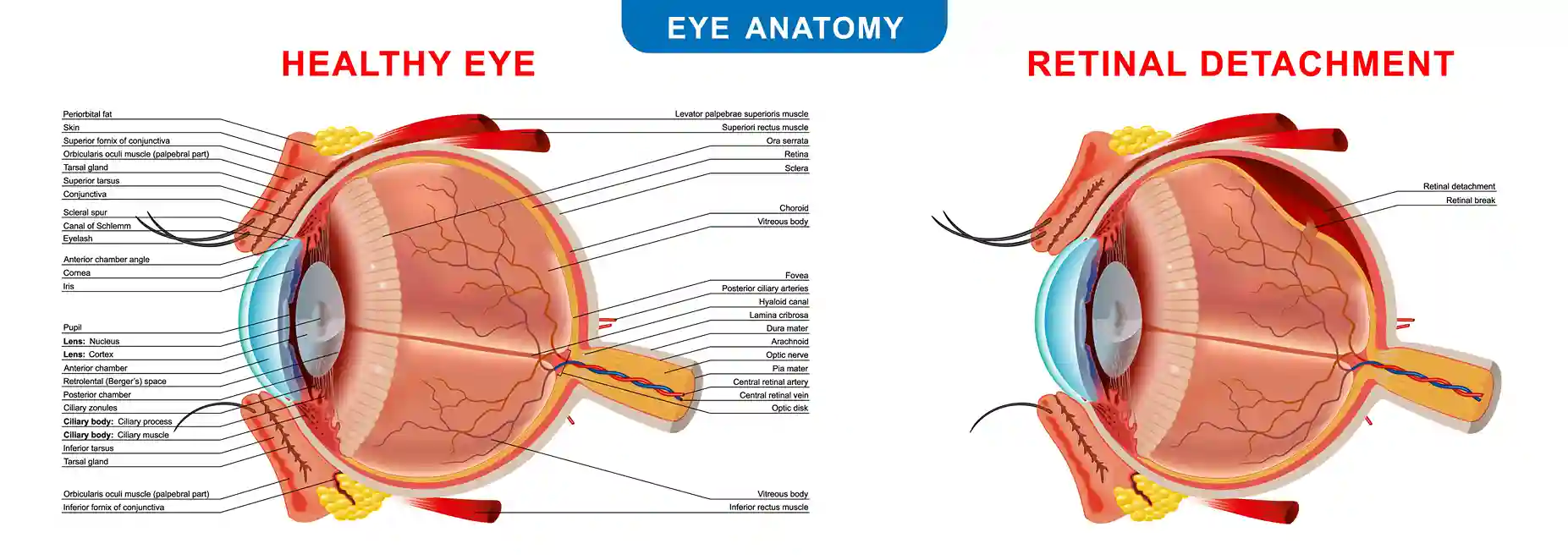 Retinal Tear Causes