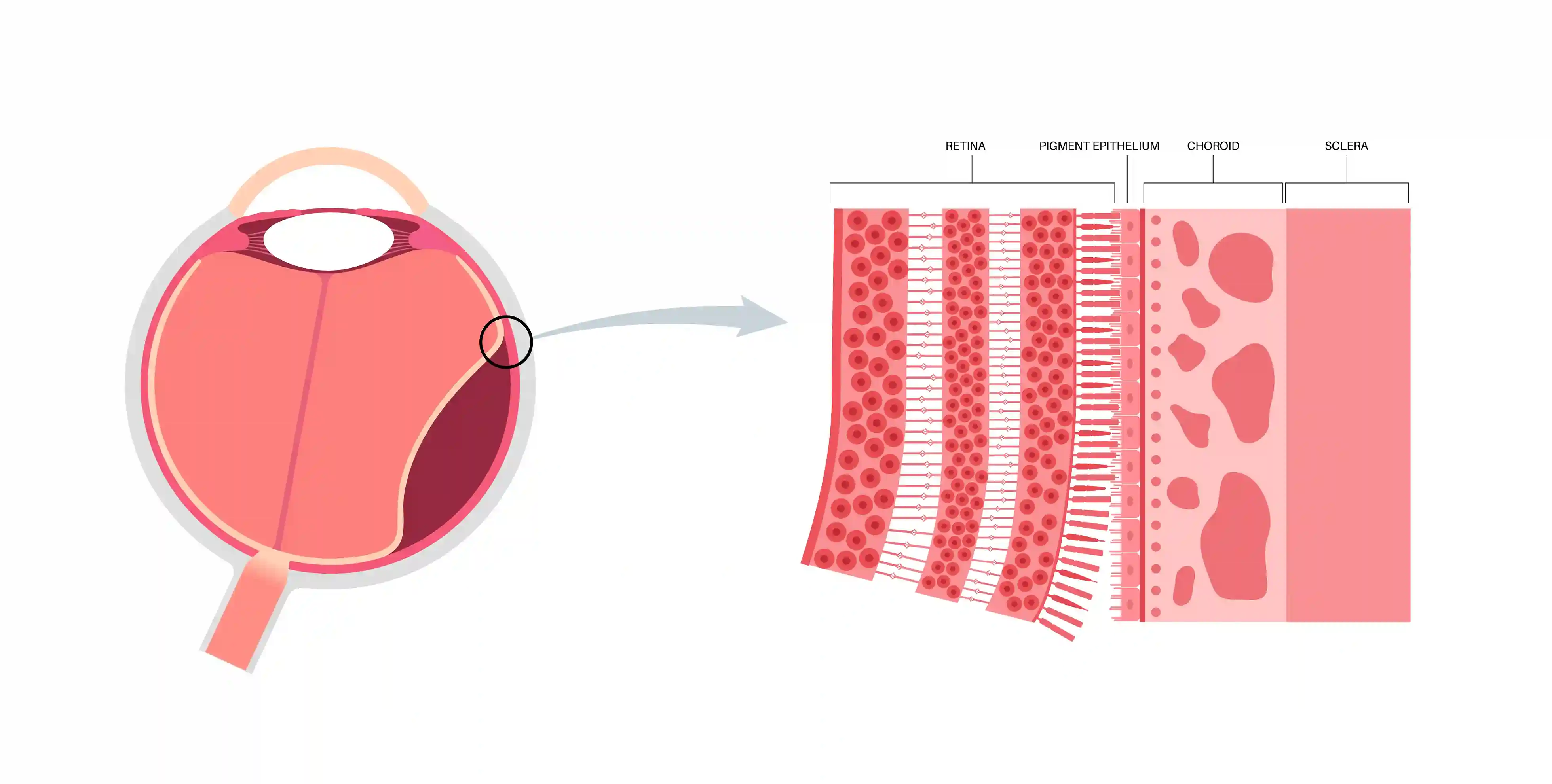 Retinal Thinning Eye