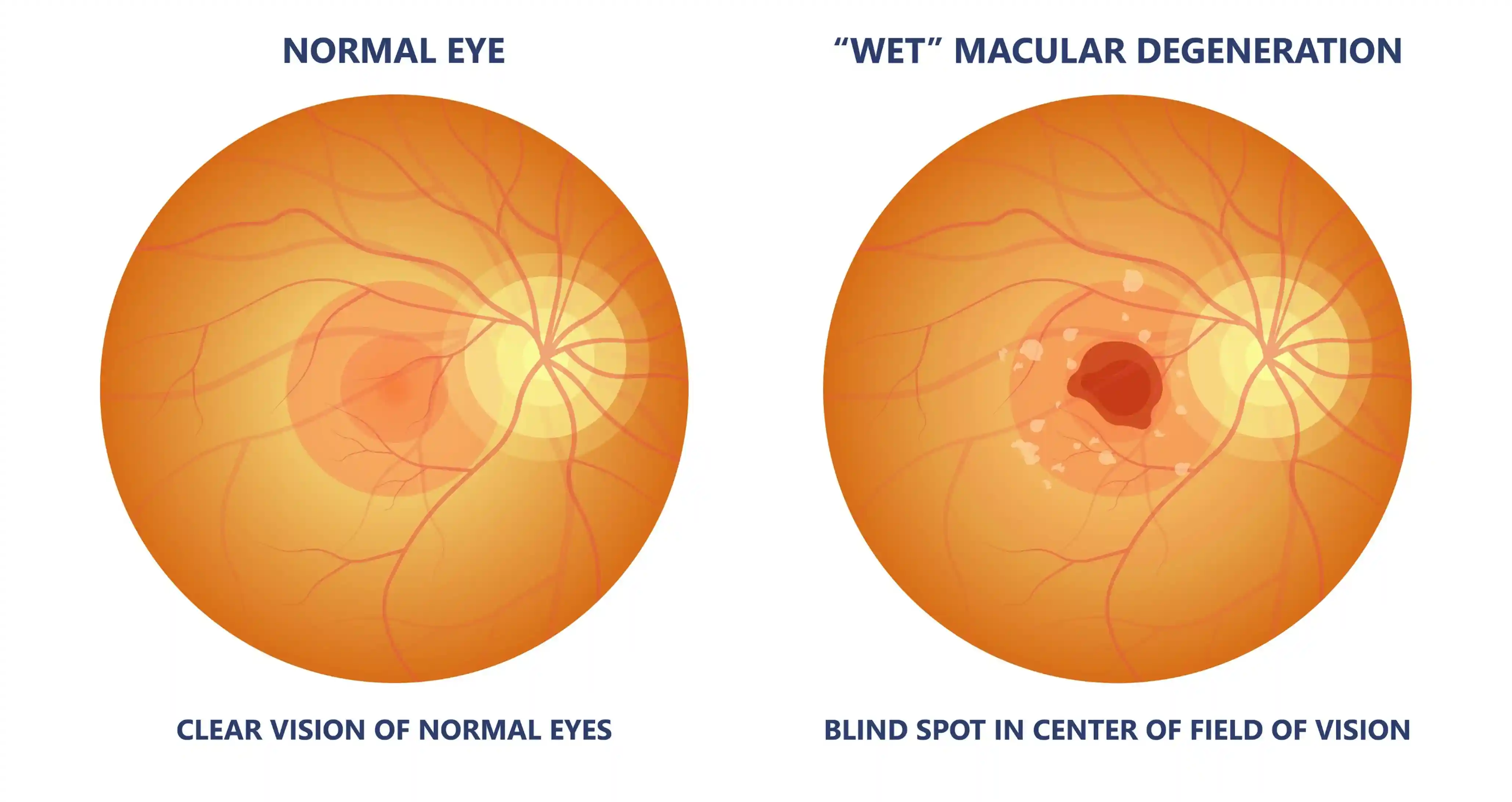 Normal vs Wet Macular Degeneration Eye