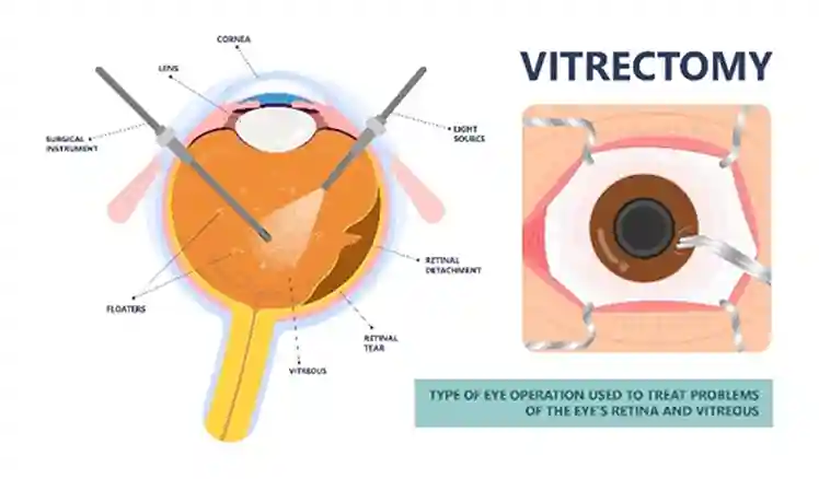Vitrectomy Surgery Diagram