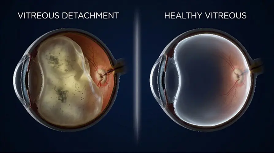 Vitreous Detachment Diagram